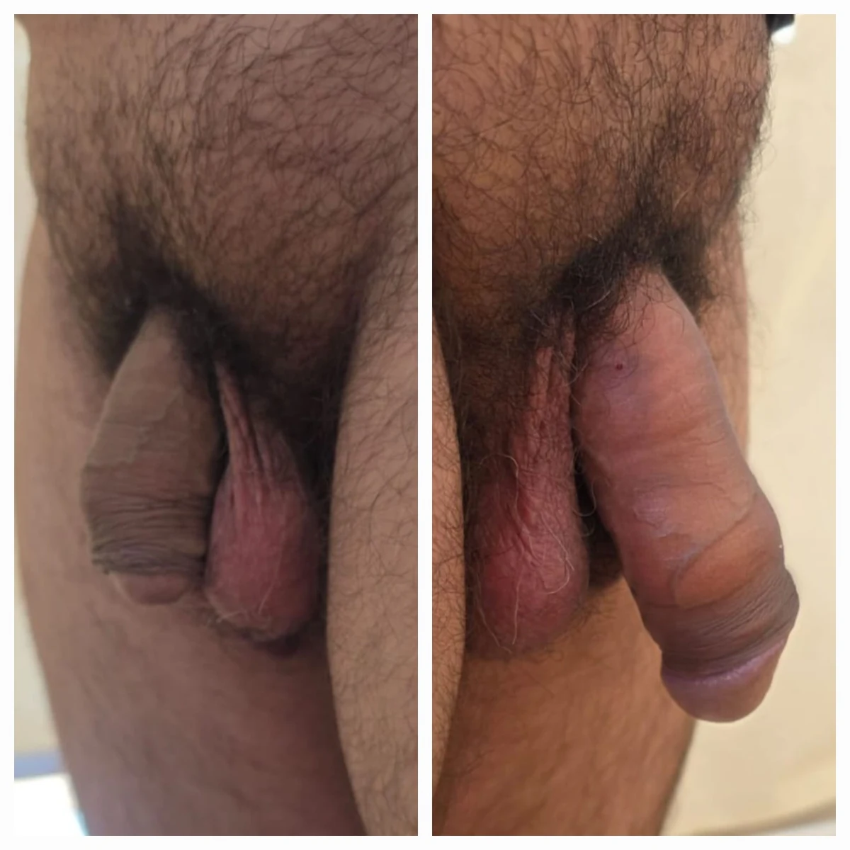 Antes e depois de harmonização íntima masculina — Método ZEUS® — Resultado 14 | Instituto Zanotti