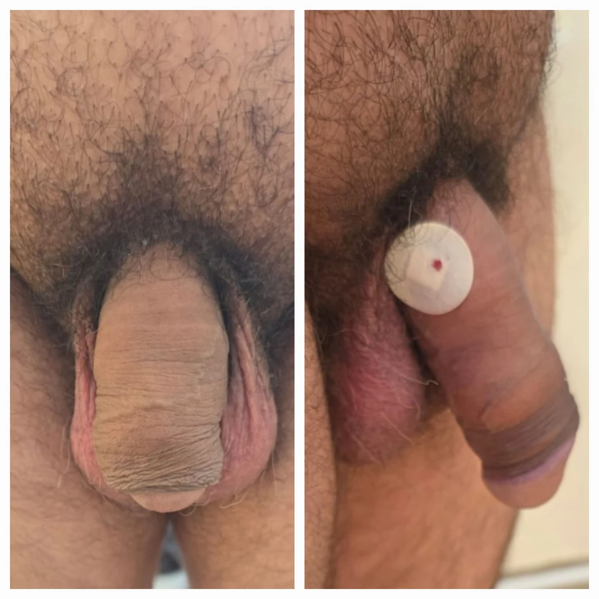 Antes e depois de harmonização íntima masculina — Método ZEUS® — Resultado 13 | Instituto Zanotti
