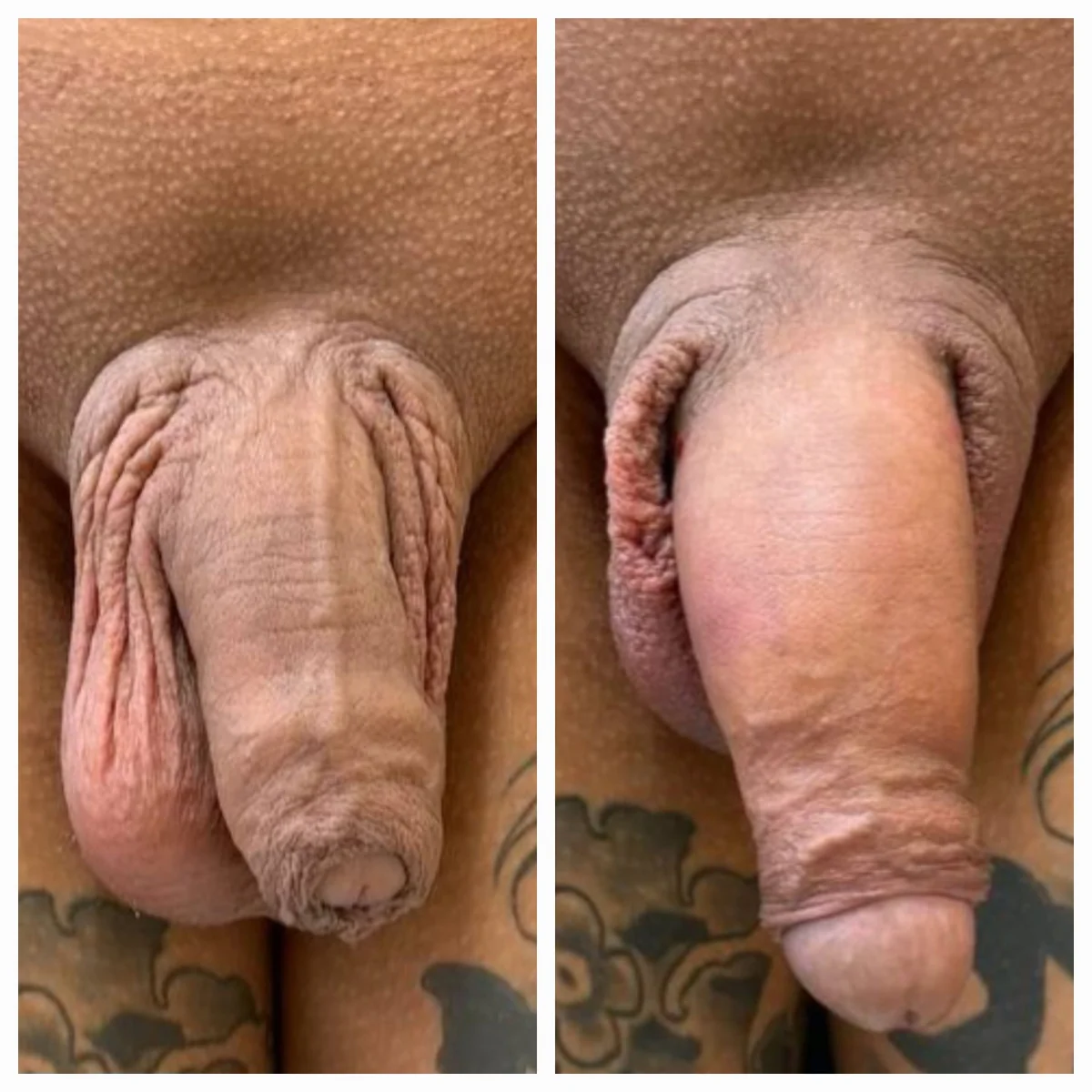 Antes e depois de harmonização íntima masculina — Método ZEUS® — Resultado 9 | Instituto Zanotti