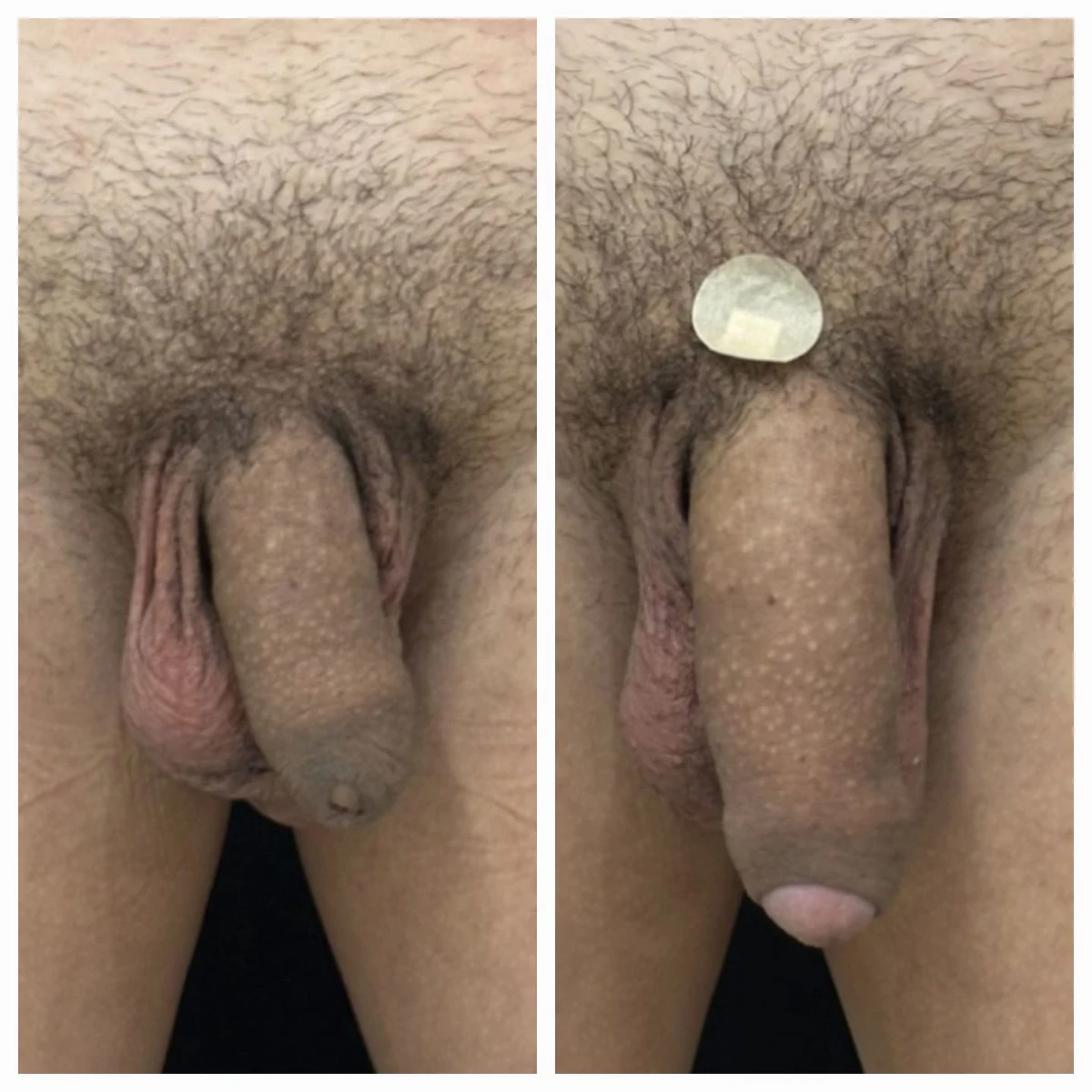 Antes e depois de harmonização íntima masculina — Método ZEUS® — Resultado 7 | Instituto Zanotti