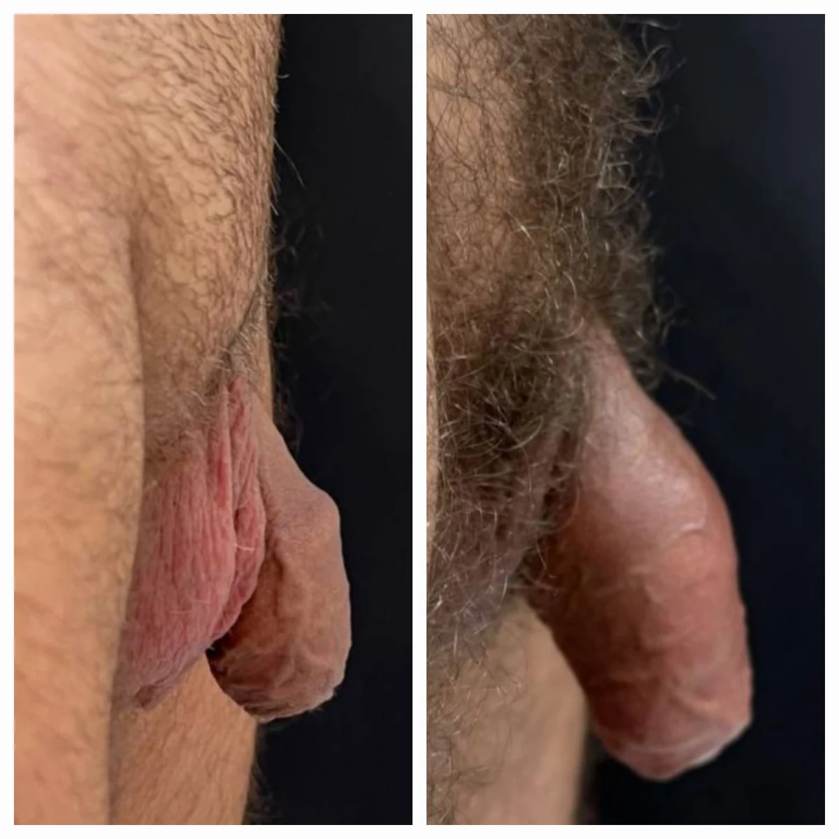 Antes e depois de harmonização íntima masculina — Método ZEUS® — Resultado 15 | Instituto Zanotti